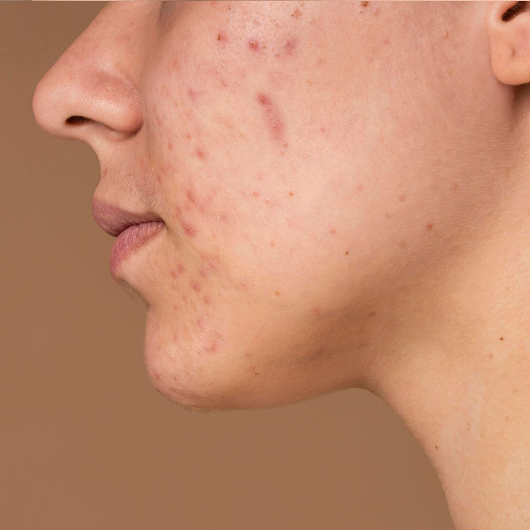 M-Aesthetic mans cheeks and chin with acne