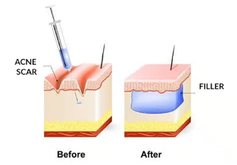 M-Aesthetic Acne Scar Filler diagram