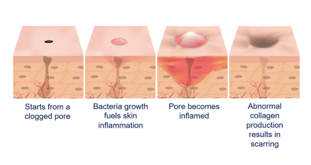 M-Aesthetic what causes acne diagram