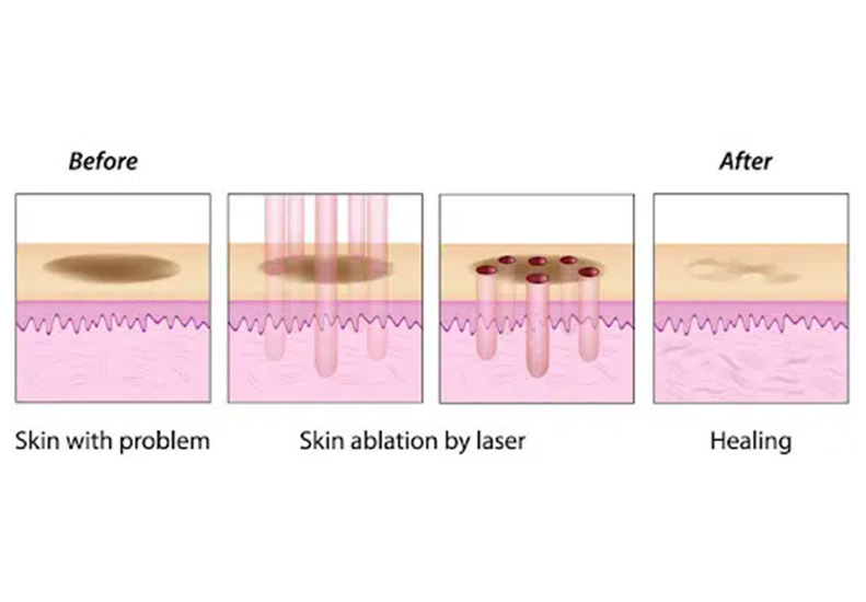 M-Aesthetic CO2 Fractional Laser Treatment diagram
