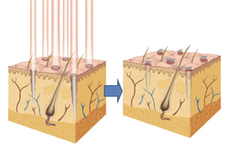 M-Aesthetic Pico Fractional Laser for Acne Scars diagram