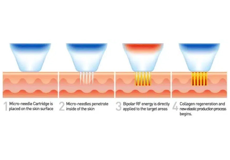 M-Aesthetic Microneedling Radiofrequency diagram