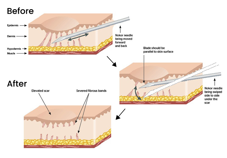 M-Aesthetic subcision for acne scars diagram
