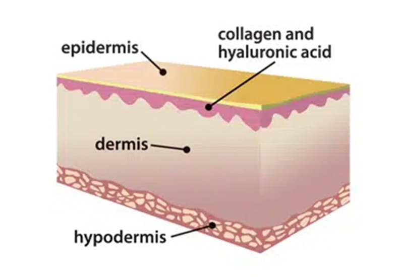 M-Aesthetic TCA CROSS Technique diagram